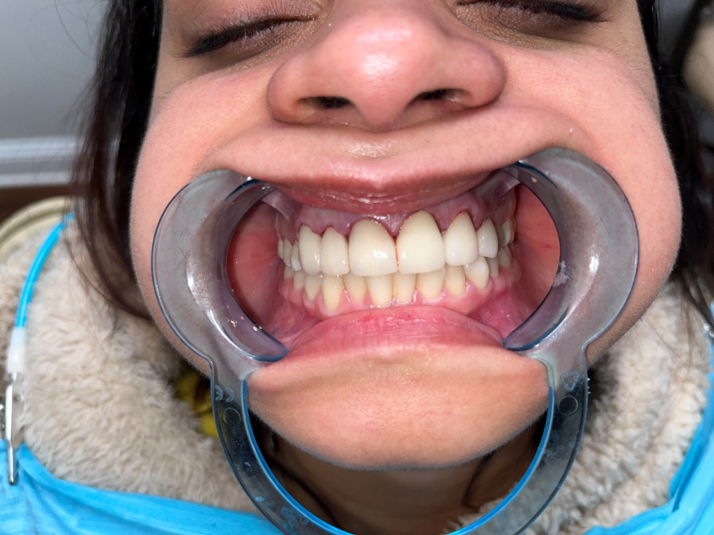 A person with a dental retractor in their mouth during treatment.