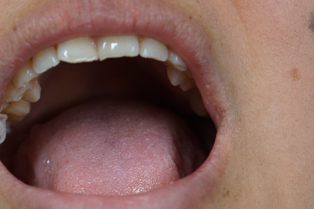 A Healthy Oral Cavity Due to Preventative Dentistry and Hygiene