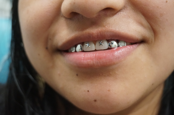 Closeup of a Girl's Front Teeth While Under Dental Treatment in Jacksonville, FL