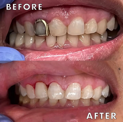 A Before and After Photo of a Permanent Tooth Procedure Performed by a Dentist in Jacksonville, FL