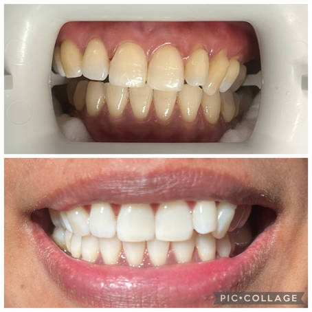 Before and after photo of professional teeth whitening.