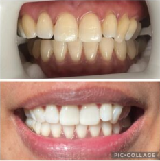 professional teeth whitening available in Jacksonville, FL.