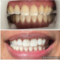 Before and after pictures following teeth whitening treatment.