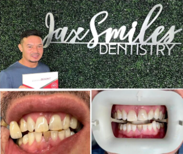 A person showing off their pearly whites post teeth whitening in Jacksonville.