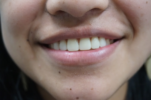 A girl proudly wearing a confident smile post-dental treatment.