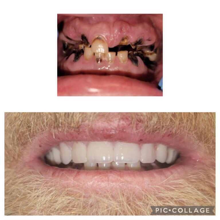 A before and after image of a person’s mouth with dental implants by Jax Smiles Dentistry