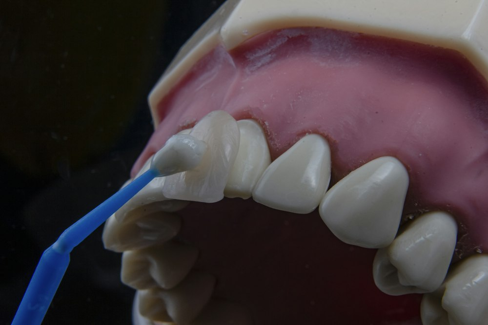 A closeup image of dental veneers being applied on a teeth model