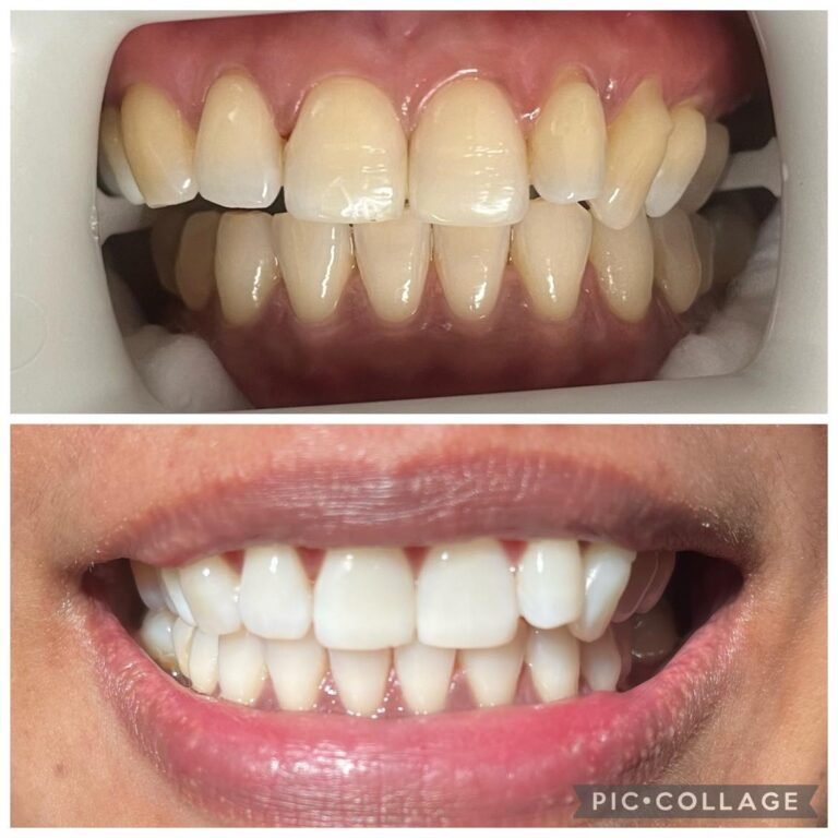 Before and after closeup picture of a patient’s teeth after teeth whitening