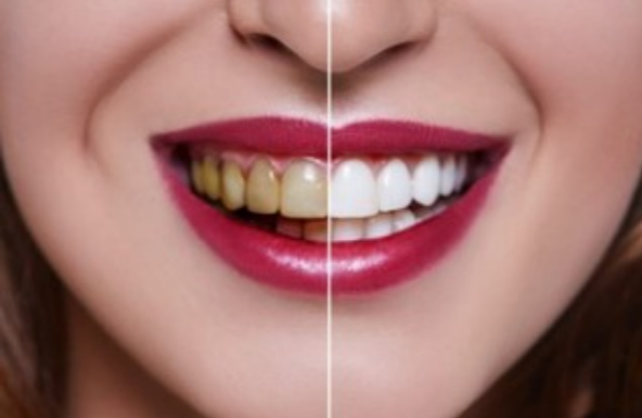 A before and after comparison of a teeth whitening procedure.