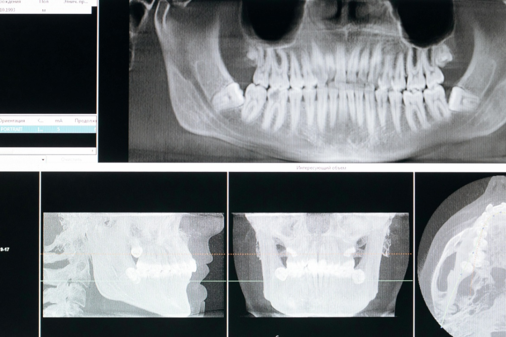 An X-ray shot of a mouth