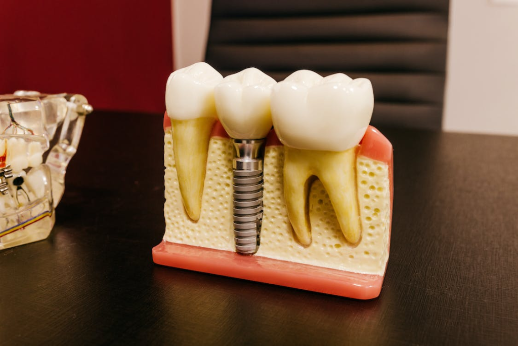 An image of a dental implant model showing a tooth placed on a titanium rod inserted in the jaw