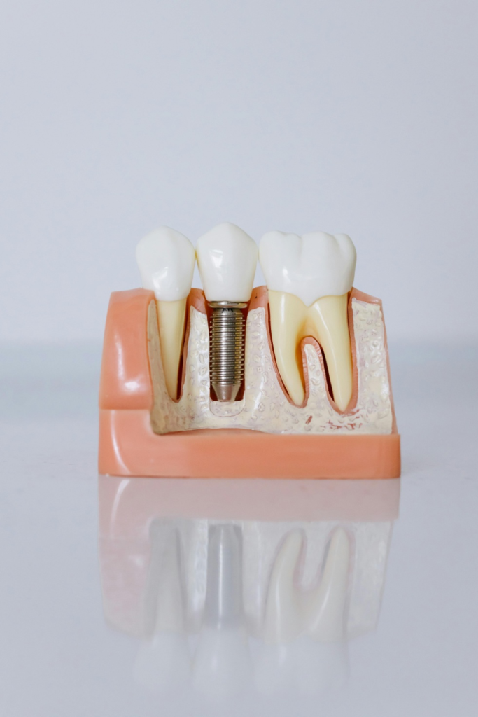 A close-up of a dental implant model